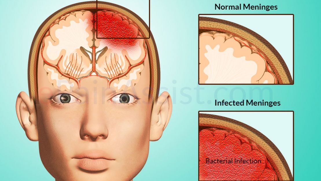 Meningitis Symptoms Causes Prevention Central Kasoa Clinic