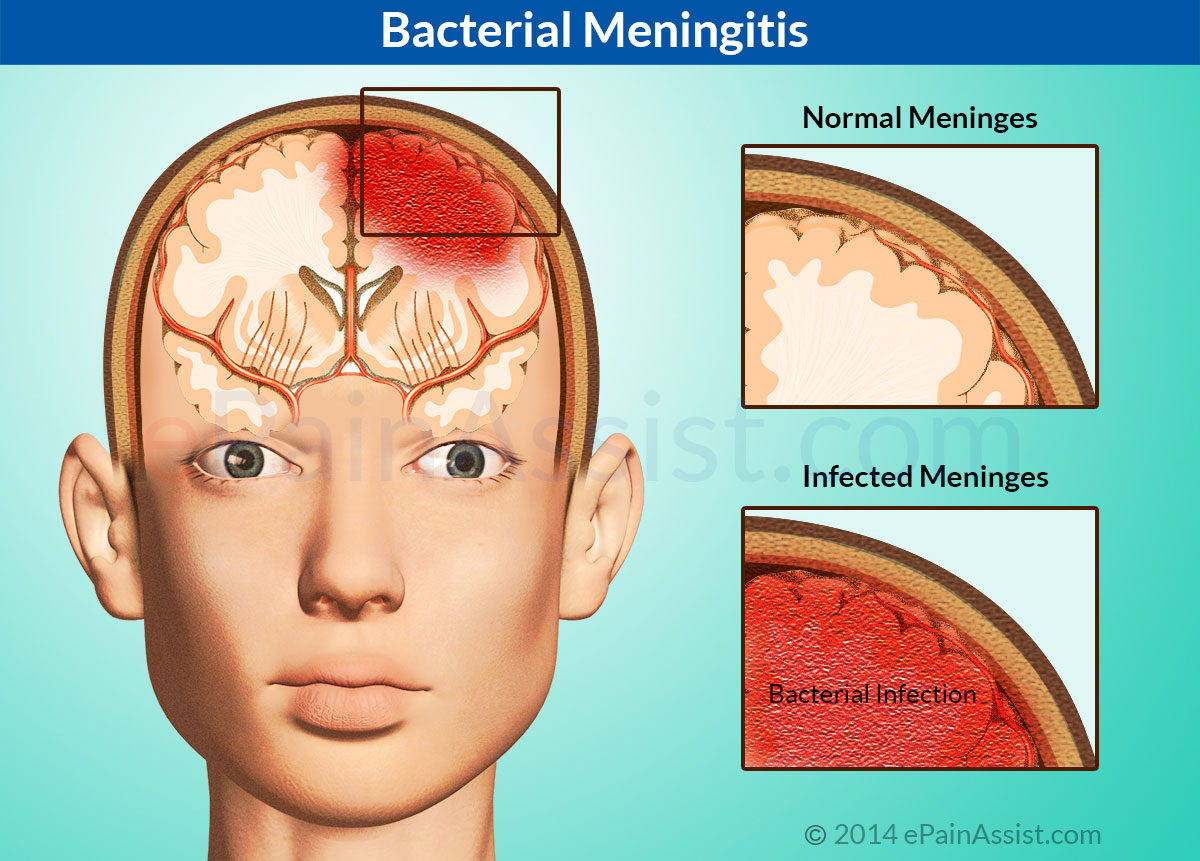 Bacterial Meningitis Diagram