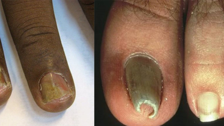 How To Prevent Bacterial Or Fungal Nail Infections Central Kasoa Clinic