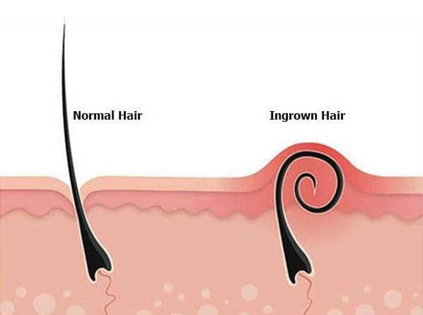 INGROWN HAIR & HOW TO PREVENT THEM